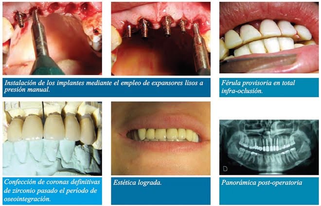 Carga Inmediata En Implantología Dentalinfo